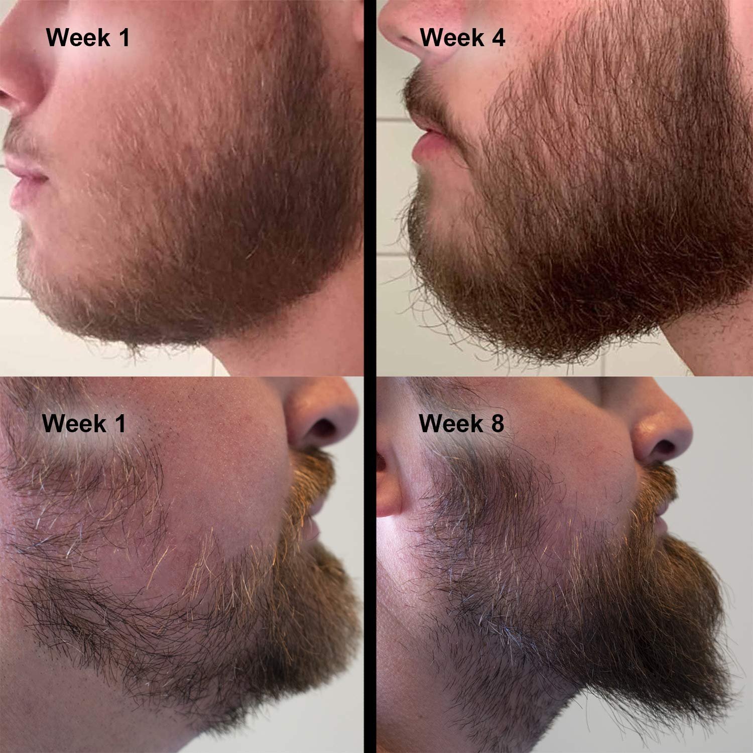 540 Titanium Micro Needle Derma Roller Beard Hair Regeneration Growth Skin  Care